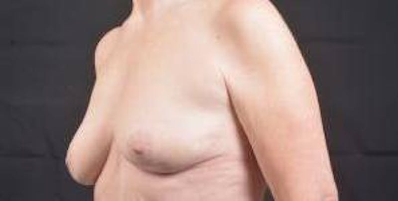 Breast Augmentation Mastopexy Before & After Gallery - Patient 759950 - Image 7