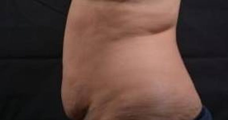 Abdominoplasty Before & After Gallery - Patient 135080 - Image 3