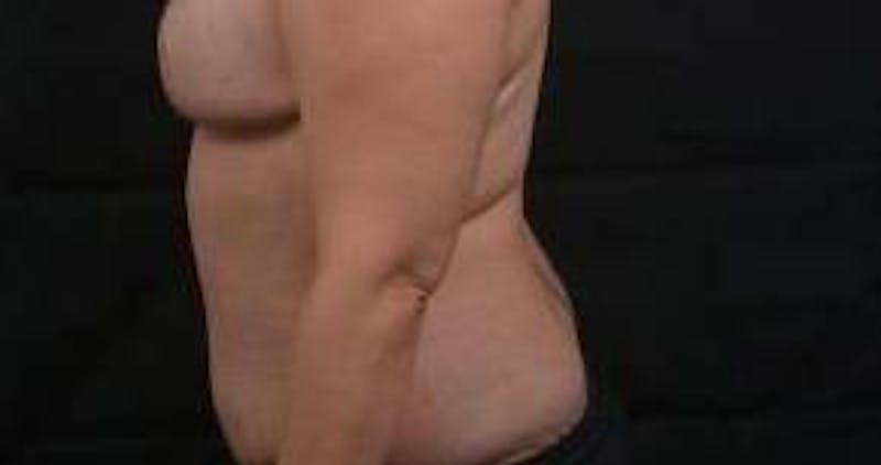 Abdominoplasty Before & After Gallery - Patient 135080 - Image 4