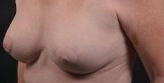 Breast Augmentation Mastopexy Before & After Gallery - Patient 759950 - Image 8
