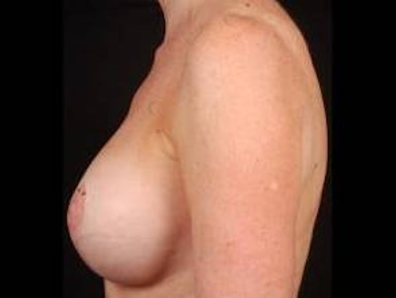 Aesthetic Breast Revision Before & After Gallery - Patient 119307 - Image 4