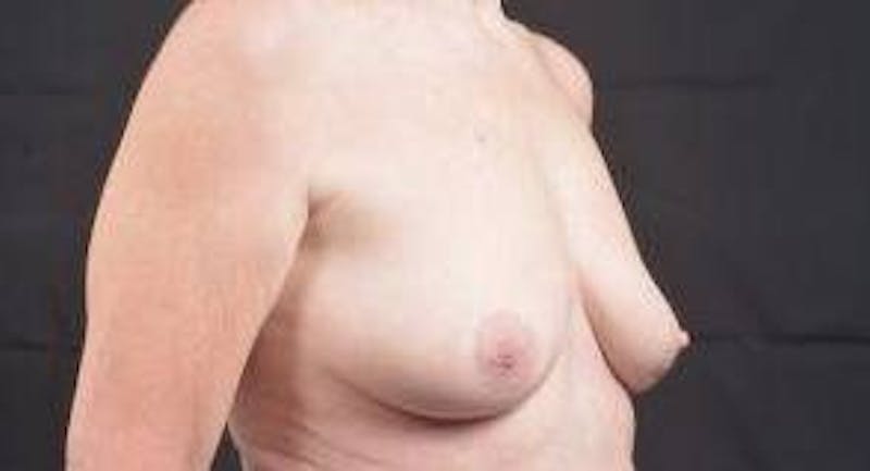 Breast Augmentation Mastopexy Before & After Gallery - Patient 759950 - Image 9