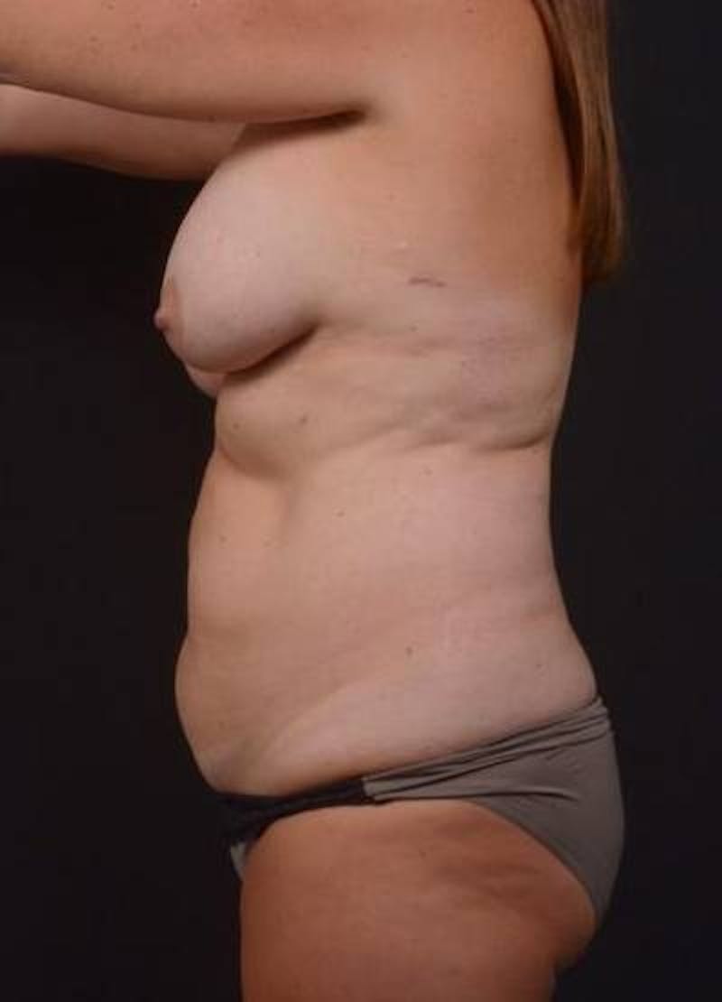 Mommy Makeover Before & After Gallery - Patient 783050 - Image 9