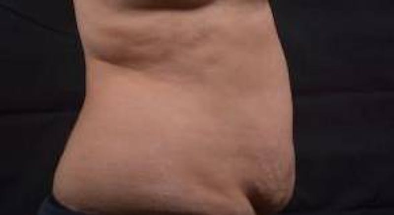 Abdominoplasty Before & After Gallery - Patient 135080 - Image 5