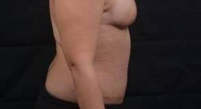 Abdominoplasty Before & After Gallery - Patient 135080 - Image 6