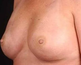 Immediate Breast Reconstruction – Nipple Sparing Before & After Gallery - Patient 273584 - Image 4