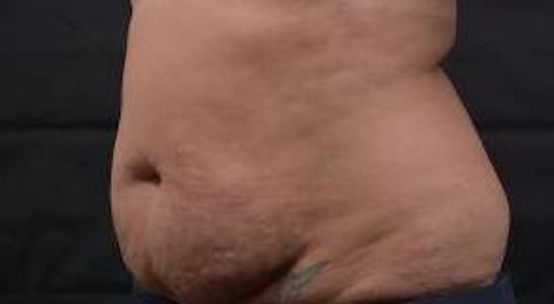Abdominoplasty Before & After Gallery - Patient 135080 - Image 7