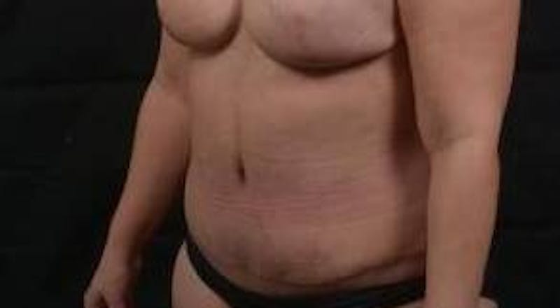 Abdominoplasty Before & After Gallery - Patient 135080 - Image 8