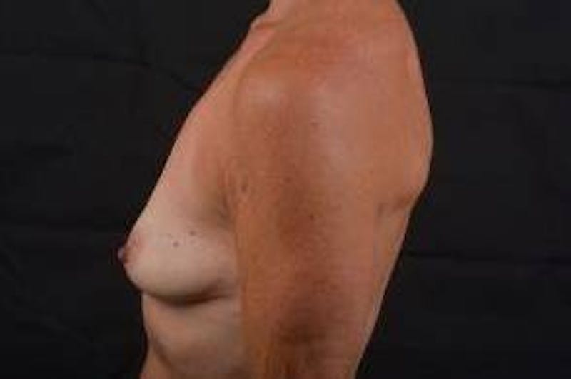Breast Augmentation Silicone Gel Before & After Gallery - Patient 957999 - Image 3