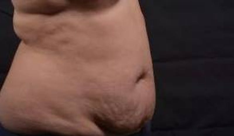 Abdominoplasty Before & After Gallery - Patient 135080 - Image 9