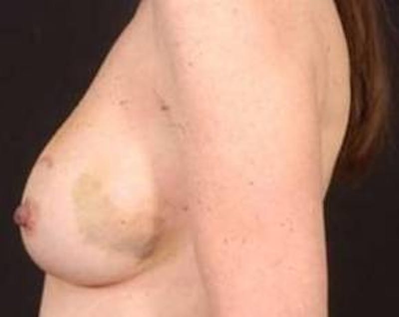 Immediate Breast Reconstruction – Nipple Sparing Before & After Gallery - Patient 160771 - Image 3