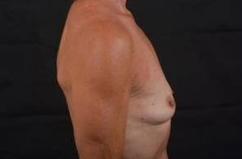 Breast Augmentation Silicone Gel Before & After Gallery - Patient 957999 - Image 5