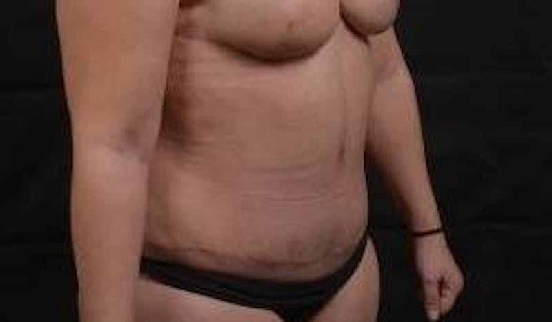 Abdominoplasty Before & After Gallery - Patient 135080 - Image 10