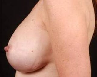 Immediate Breast Reconstruction – Nipple Sparing Before & After Gallery - Patient 160771 - Image 4
