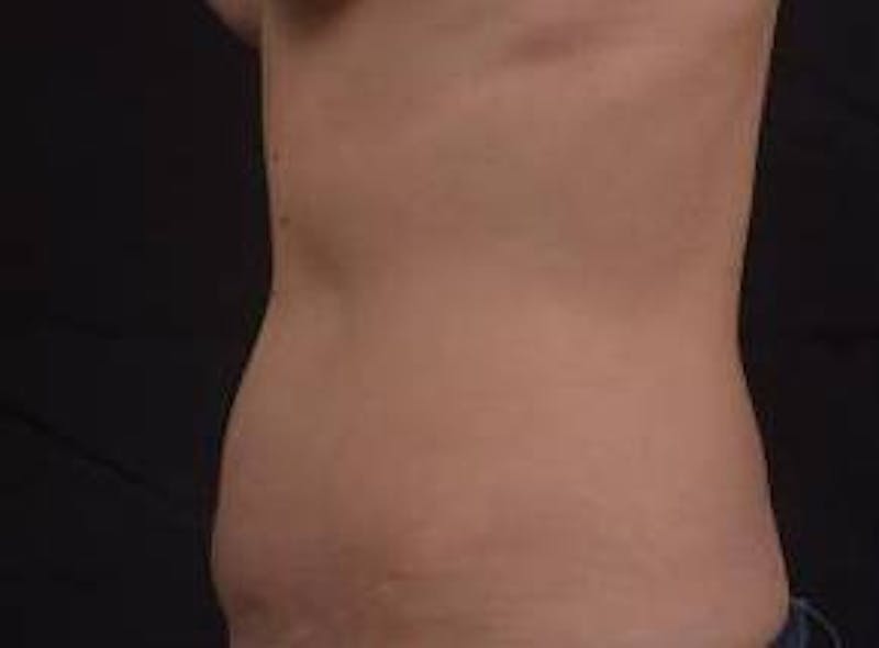 Abdominoplasty Before & After Gallery - Patient 269362 - Image 3
