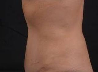 Abdominoplasty Before & After Gallery - Patient 269362 - Image 4