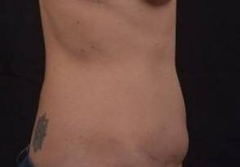 Abdominoplasty Before & After Gallery - Patient 269362 - Image 5