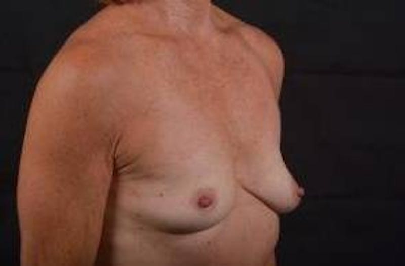 Breast Augmentation Silicone Gel Before & After Gallery - Patient 957999 - Image 9