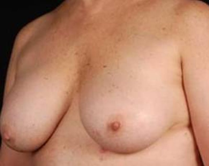 Immediate Breast Reconstruction – Nipple Sparing Before & After Gallery - Patient 350680 - Image 3