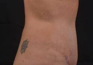 Abdominoplasty Before & After Gallery - Patient 269362 - Image 6