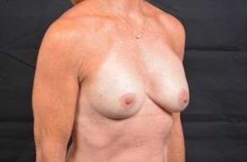 Breast Augmentation Silicone Gel Before & After Gallery - Patient 957999 - Image 10