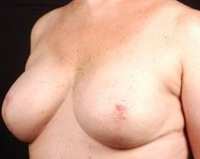 Immediate Breast Reconstruction – Nipple Sparing Before & After Gallery - Patient 350680 - Image 4
