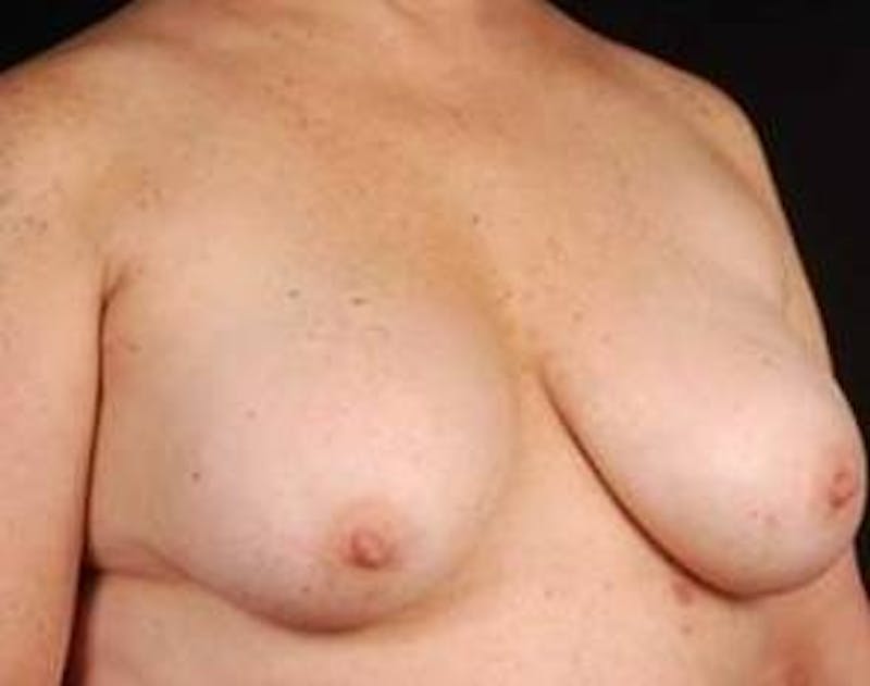 Immediate Breast Reconstruction – Nipple Sparing Before & After Gallery - Patient 350680 - Image 5