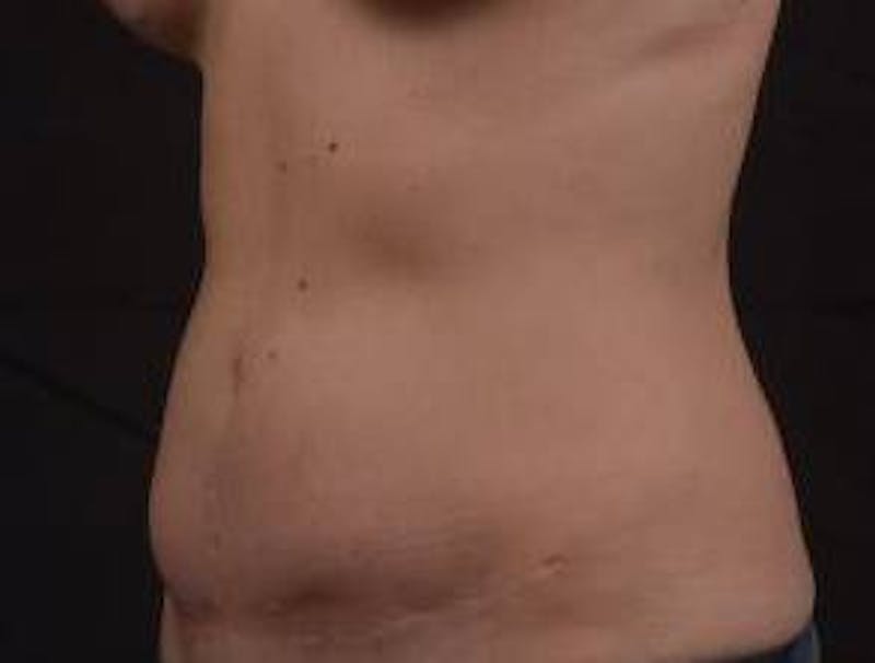 Abdominoplasty Before & After Gallery - Patient 269362 - Image 7