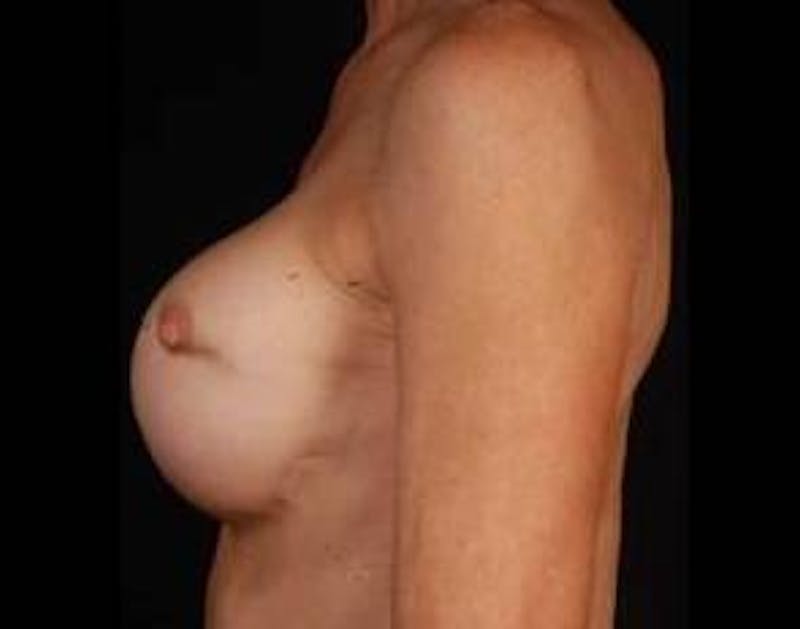 Aesthetic Breast Revision Before & After Gallery - Patient 418118 - Image 3