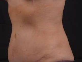 Abdominoplasty Before & After Gallery - Patient 269362 - Image 8