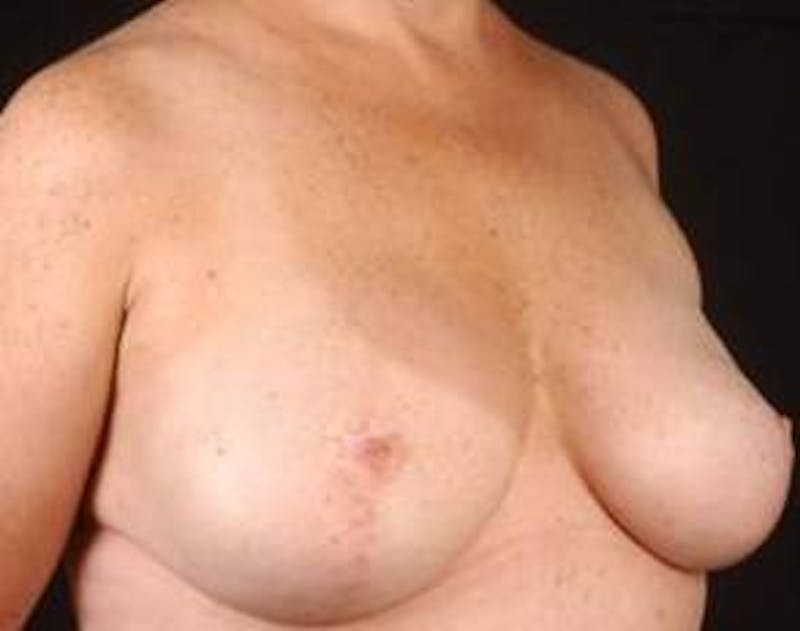 Immediate Breast Reconstruction – Nipple Sparing Before & After Gallery - Patient 350680 - Image 6