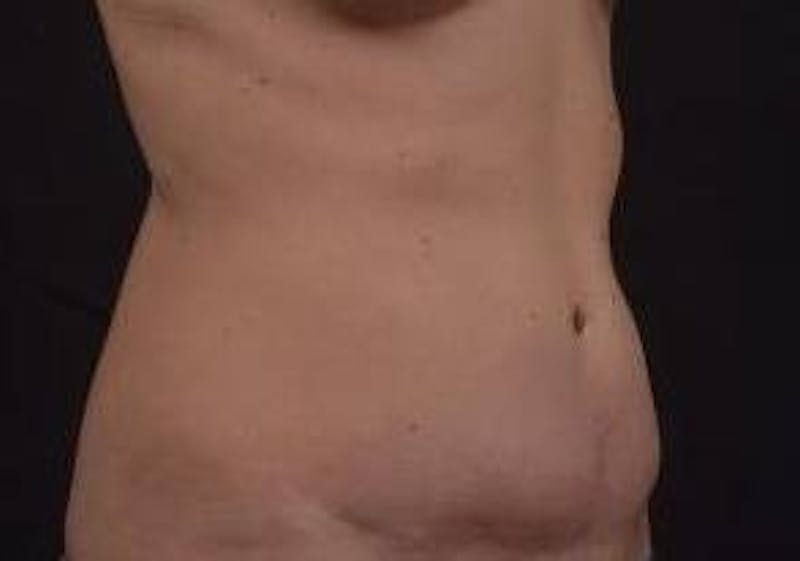 Abdominoplasty Before & After Gallery - Patient 269362 - Image 9