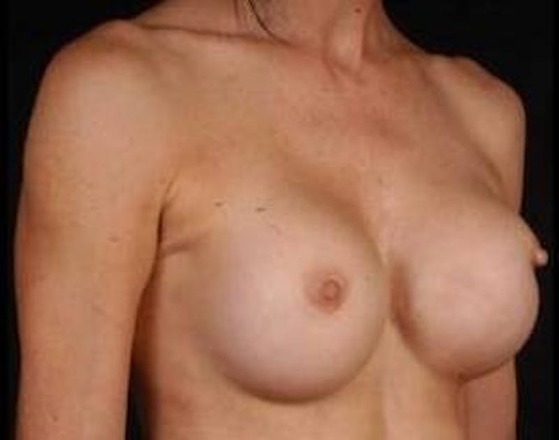 Aesthetic Breast Revision Before & After Gallery - Patient 418118 - Image 5