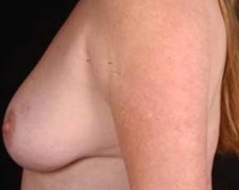 Immediate Breast Reconstruction – Nipple Sparing Before & After Gallery - Patient 155947 - Image 3