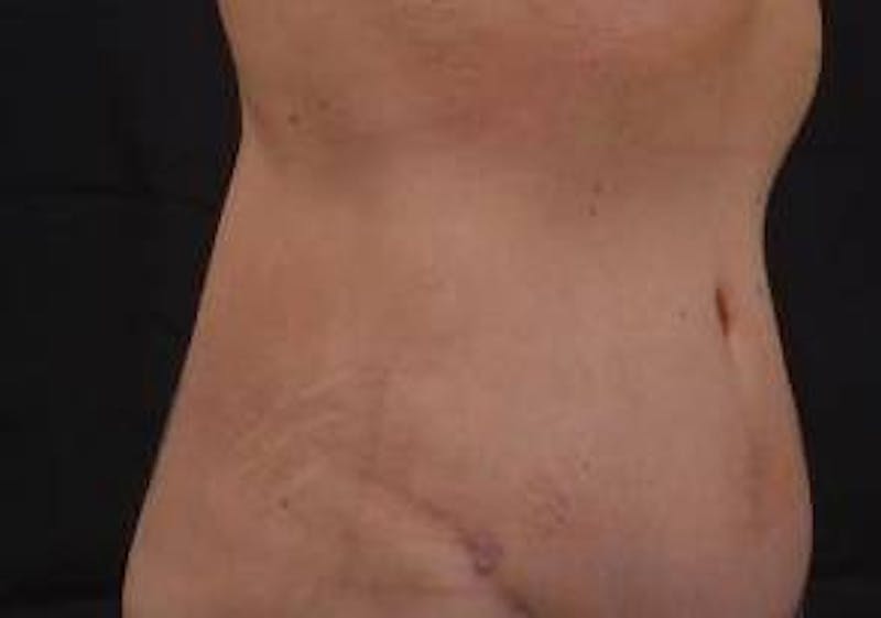 Abdominoplasty Before & After Gallery - Patient 269362 - Image 10