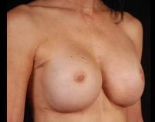 Aesthetic Breast Revision Before & After Gallery - Patient 418118 - Image 6