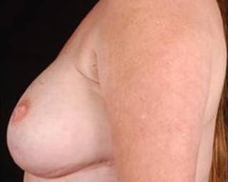 Immediate Breast Reconstruction – Nipple Sparing Before & After Gallery - Patient 155947 - Image 4