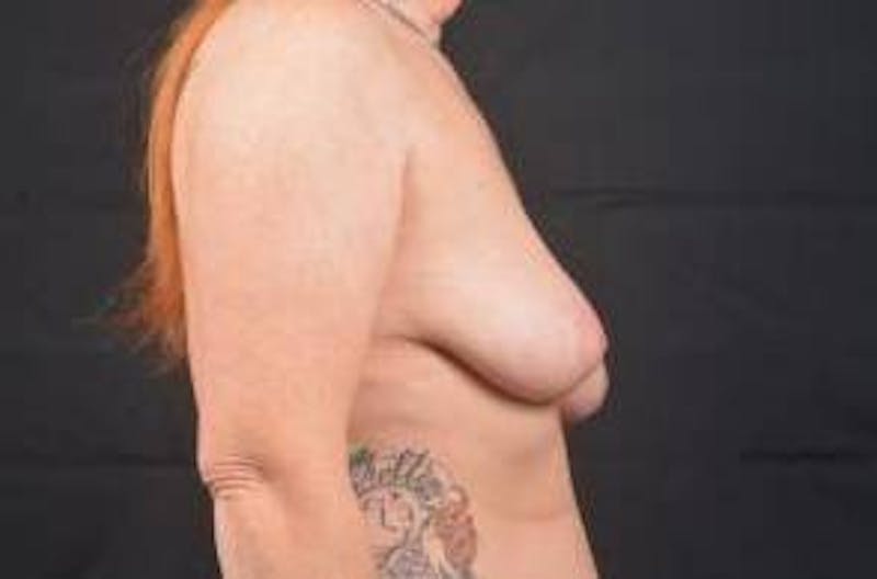 Breast Augmentation Mastopexy Before & After Gallery - Patient 505060 - Image 5
