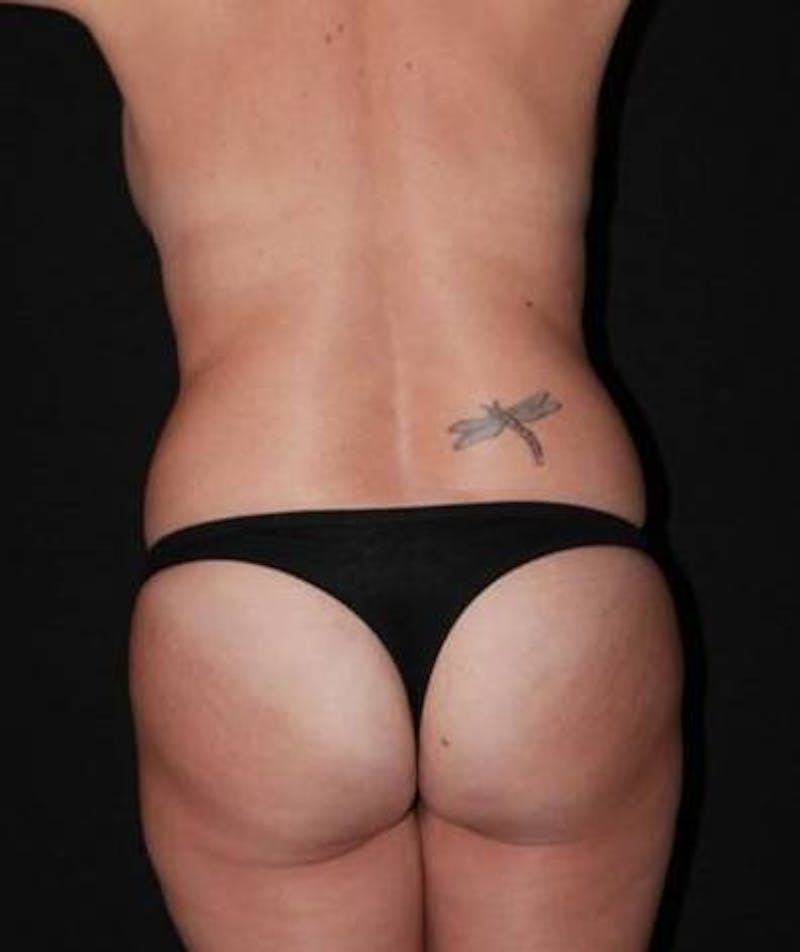 Mommy Makeover Before & After Gallery - Patient 410478 - Image 9