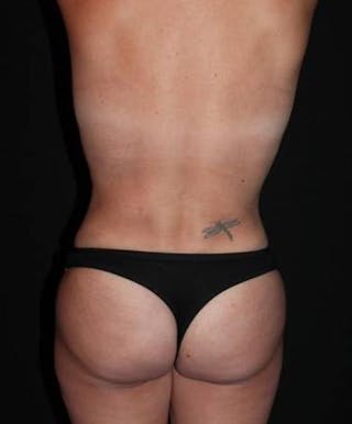 Mommy Makeover Before & After Gallery - Patient 410478 - Image 10