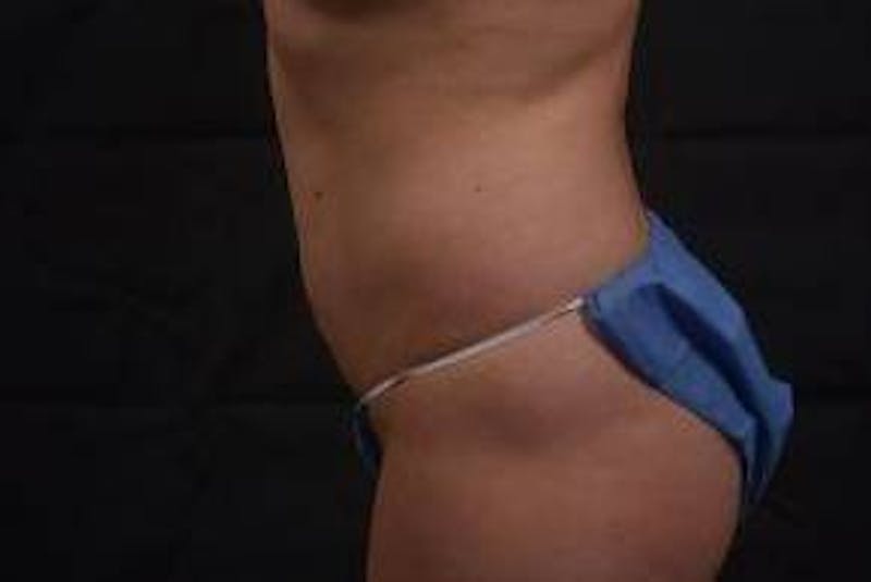 Abdominoplasty Before & After Gallery - Patient 342786 - Image 3