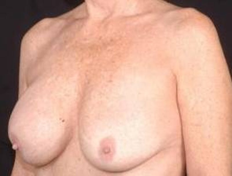 Aesthetic Breast Revision Before & After Gallery - Patient 161893 - Image 3
