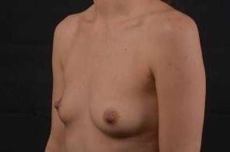 Breast Augmentation Silicone Gel Before & After Gallery - Patient 903878 - Image 7