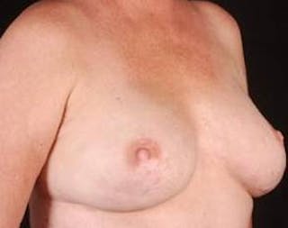 Immediate Breast Reconstruction – Nipple Sparing Before & After Gallery - Patient 155947 - Image 6
