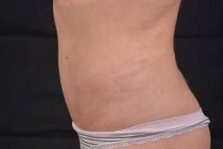 Abdominoplasty Before & After Gallery - Patient 342786 - Image 4