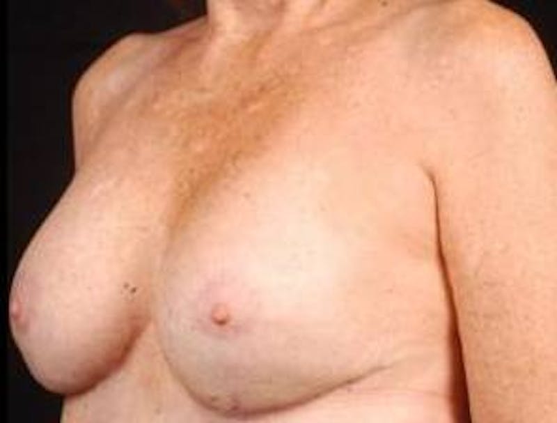 Aesthetic Breast Revision Before & After Gallery - Patient 161893 - Image 4