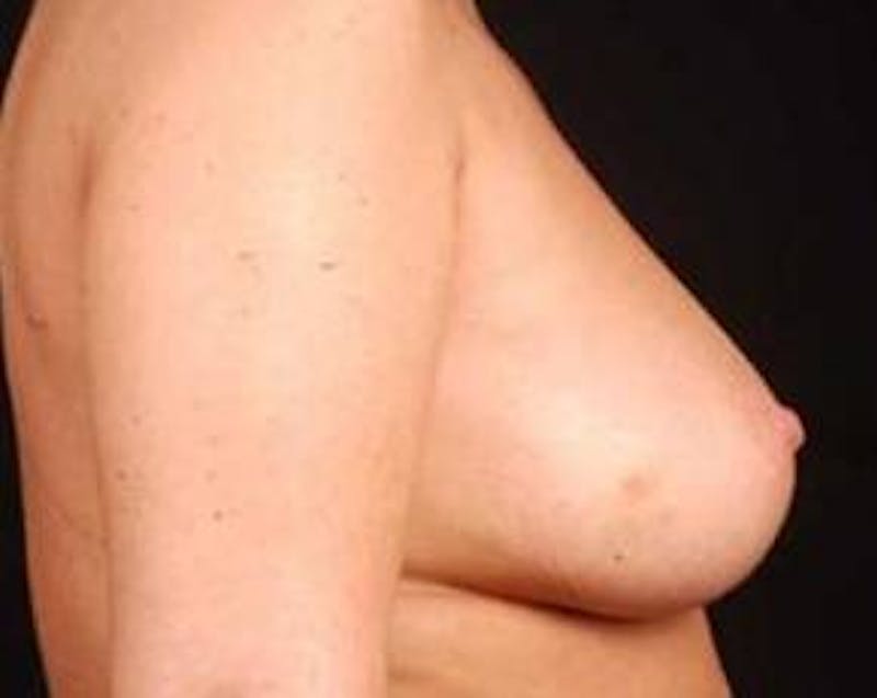 Immediate Breast Reconstruction – Nipple Sparing Before & After Gallery - Patient 357281 - Image 3