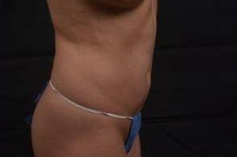 Abdominoplasty Before & After Gallery - Patient 342786 - Image 5