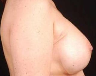 Immediate Breast Reconstruction – Nipple Sparing Before & After Gallery - Patient 357281 - Image 4