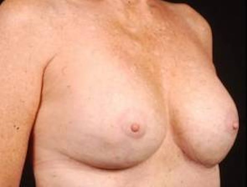 Aesthetic Breast Revision Before & After Gallery - Patient 161893 - Image 6